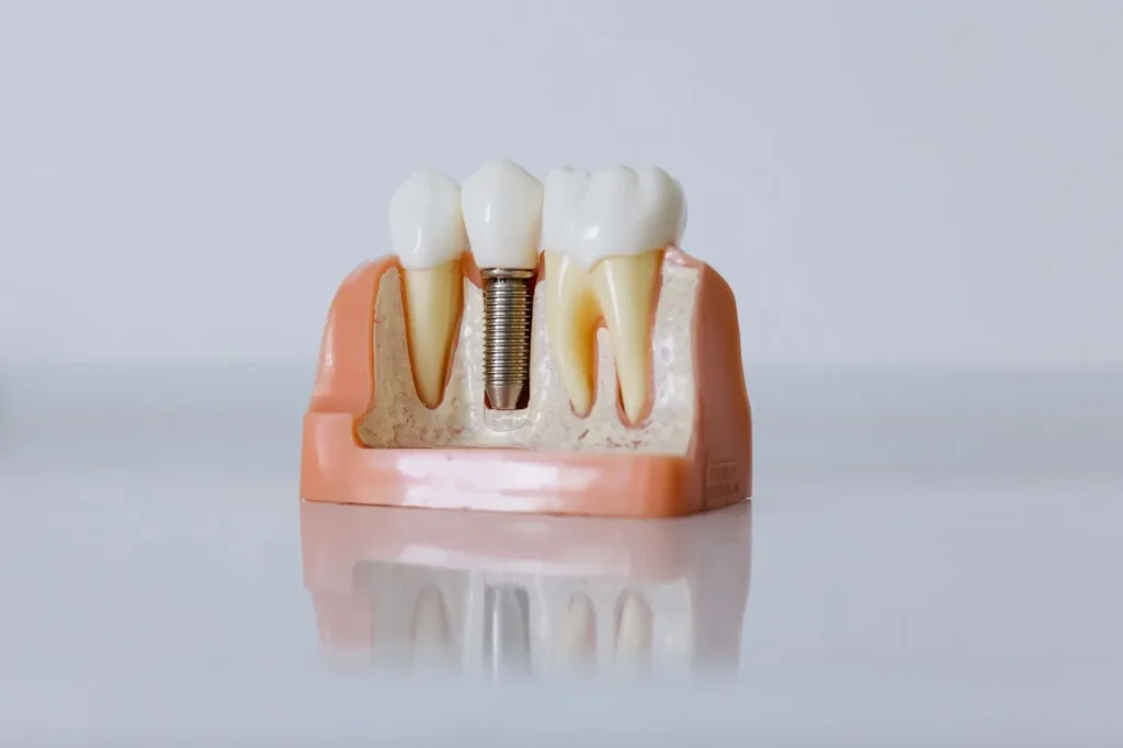 Model zubnog implantata