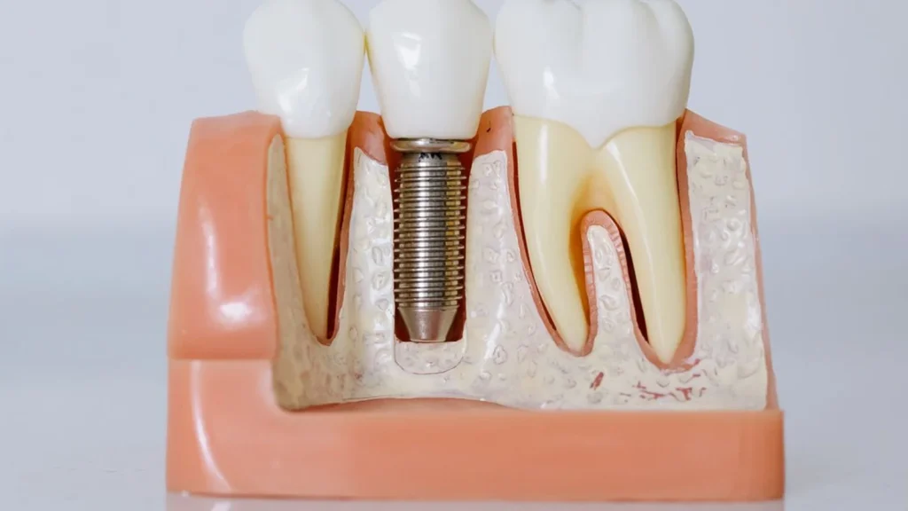 Edukativni model zuba sa dentalnim implantatom