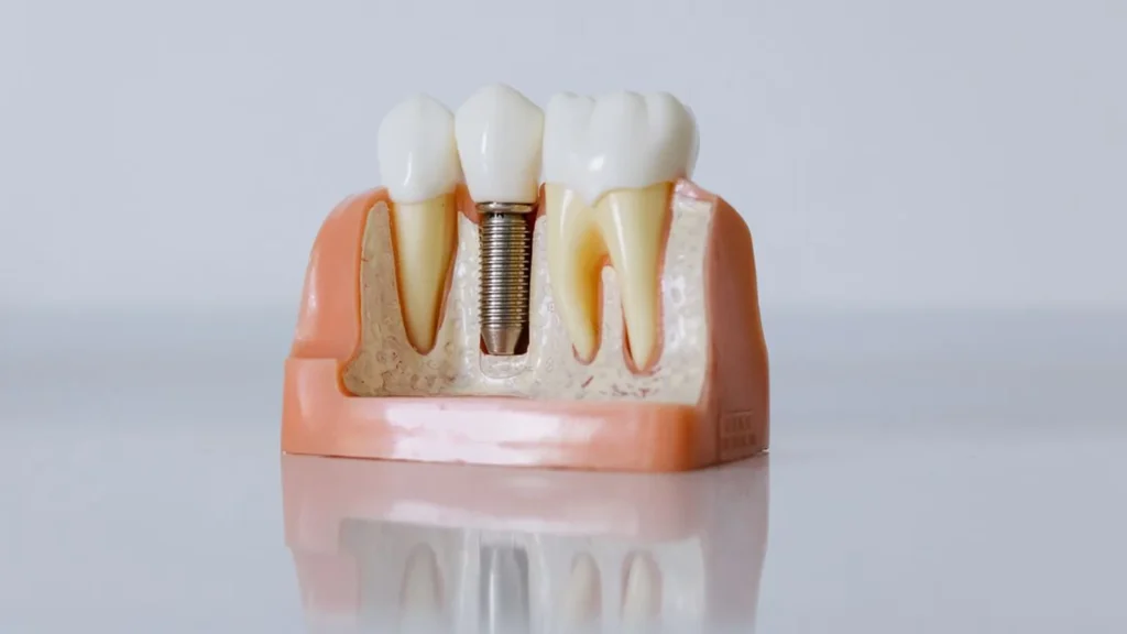 Edukativni model dentalnog implantata i okolnih zuba